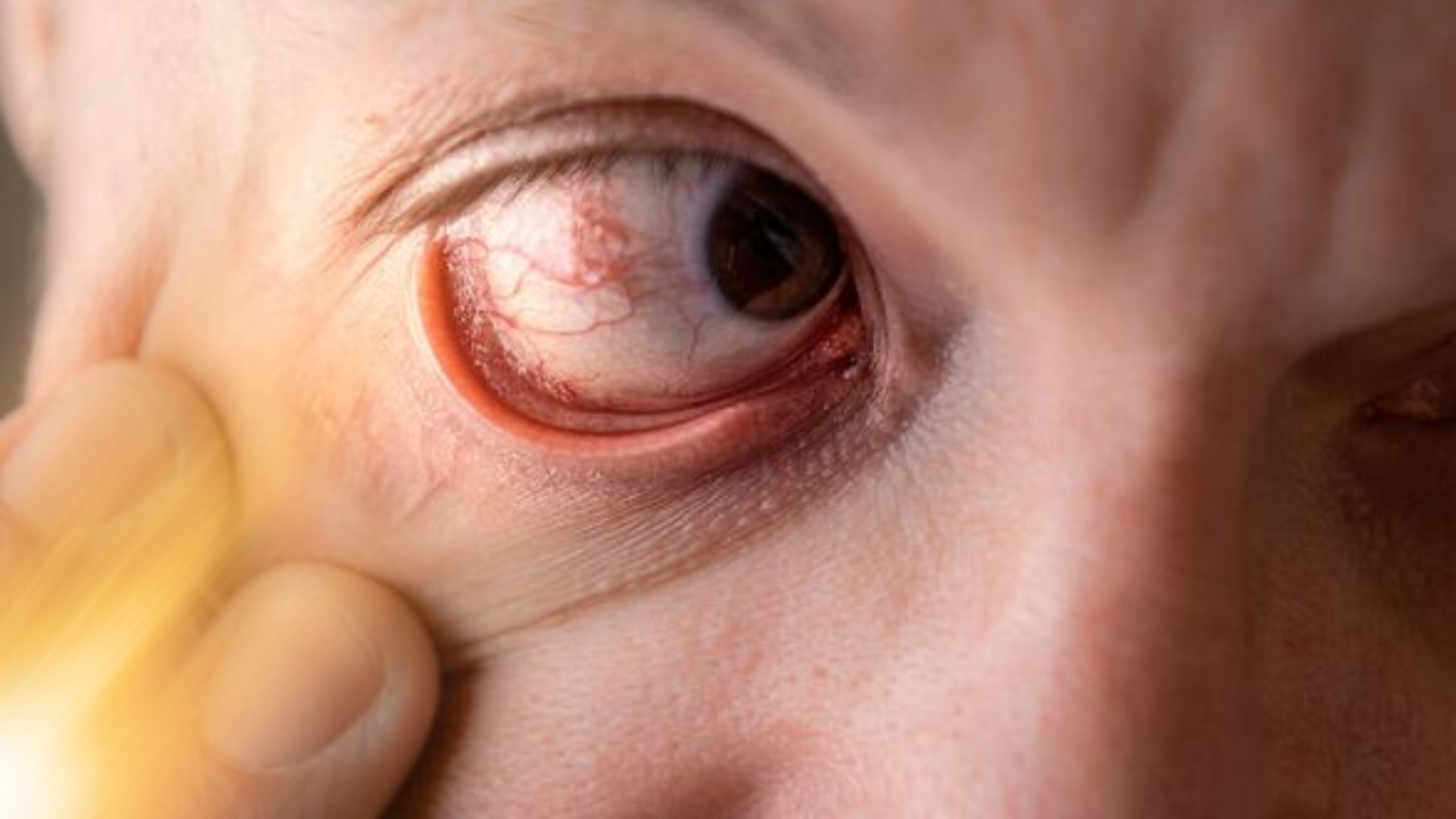 Eye Strokes Are Common In Summers, Know Causes, Symptoms and Prevention