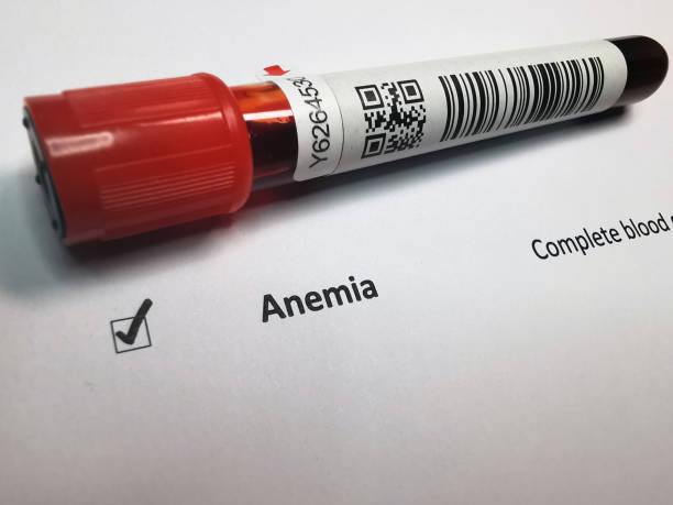 7 Surprising Causes Of Anemia You Might Not Know About