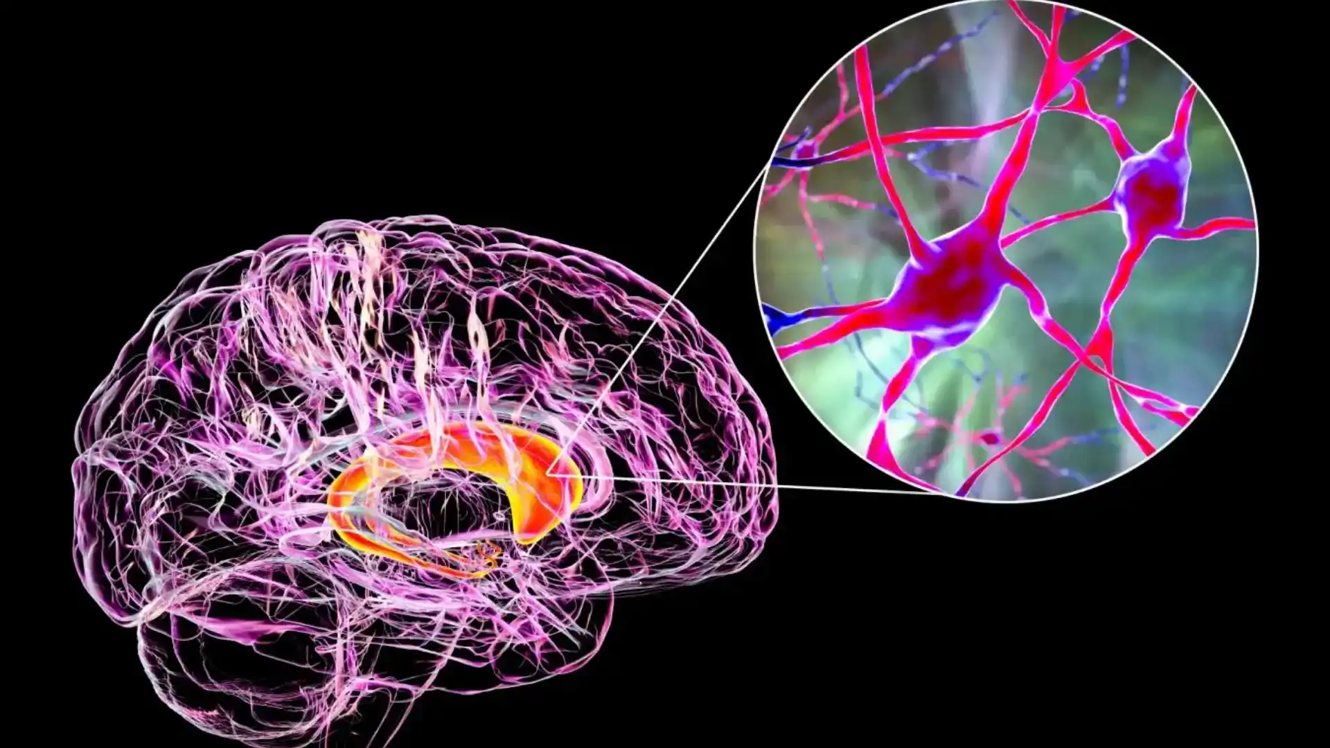 Breakthrough: New Gene Linked To Huntington’s Disease Progression