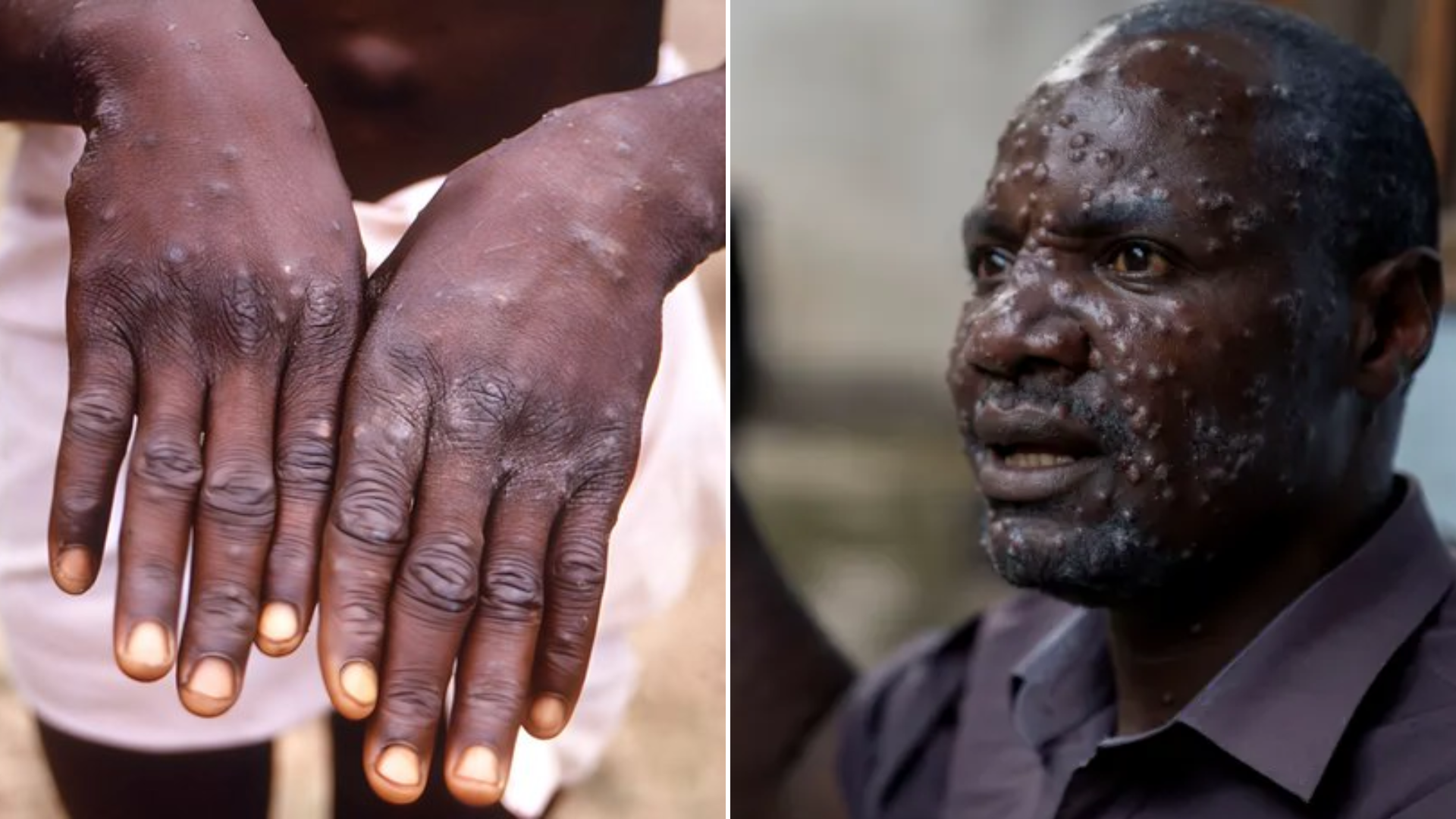 Pourquoi le ‘Mpox’ a-t-il été déclaré une urgence mondiale ? Causes et symptômes expliqués