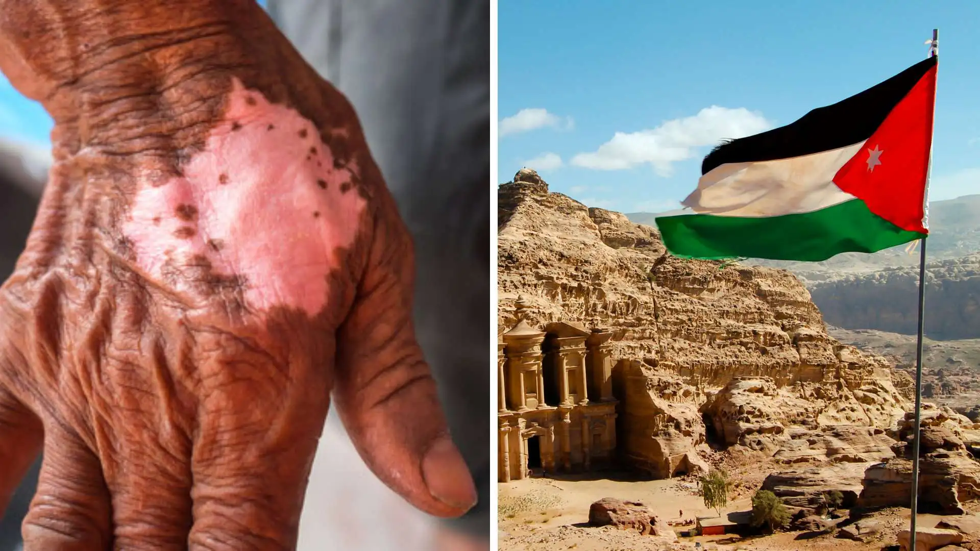 Jordan Becomes The First Country Verified By WHO For Eliminating Leprosy