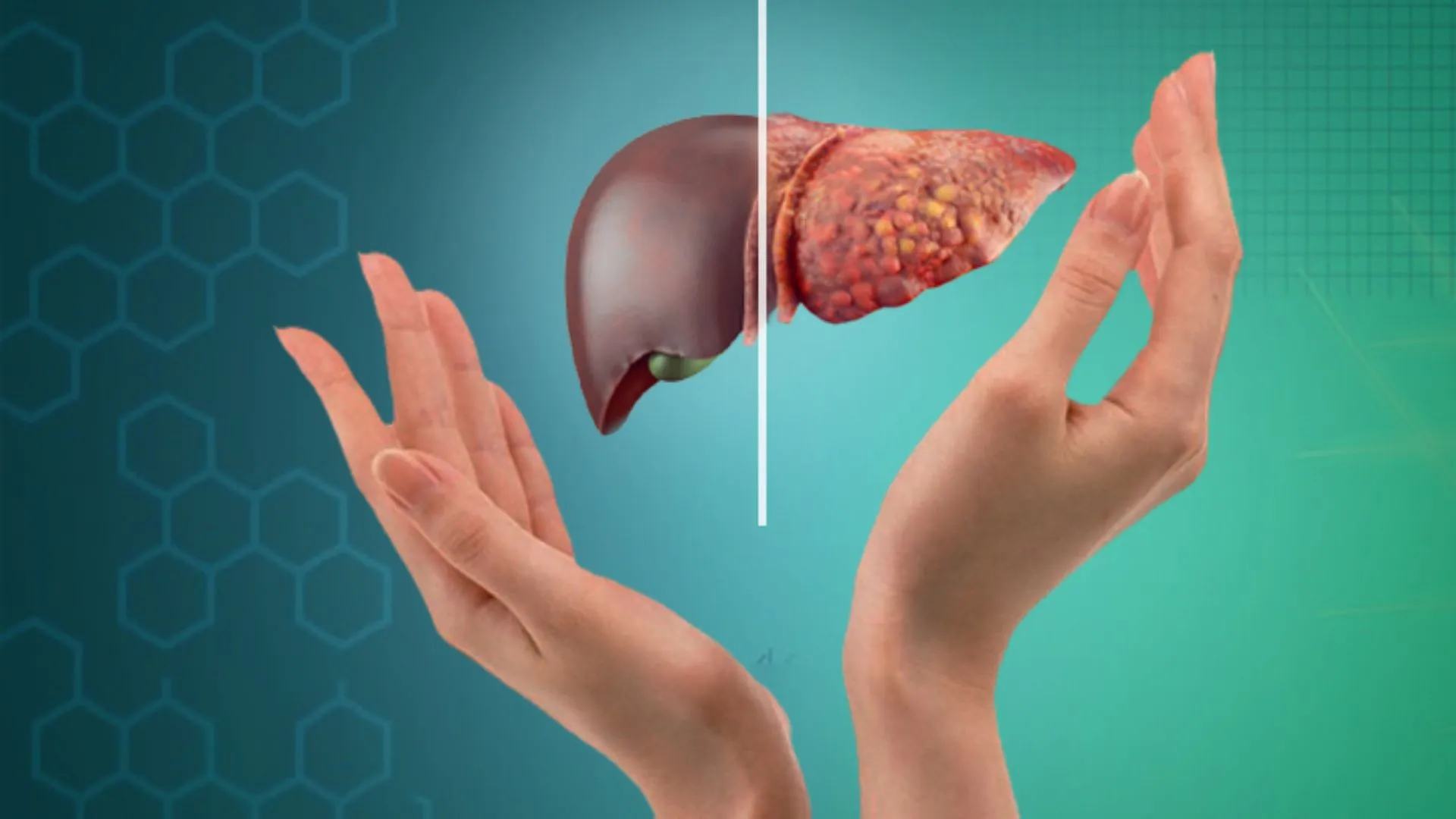 Lifestyle Changes To Prevent And Treat Fatty Liver