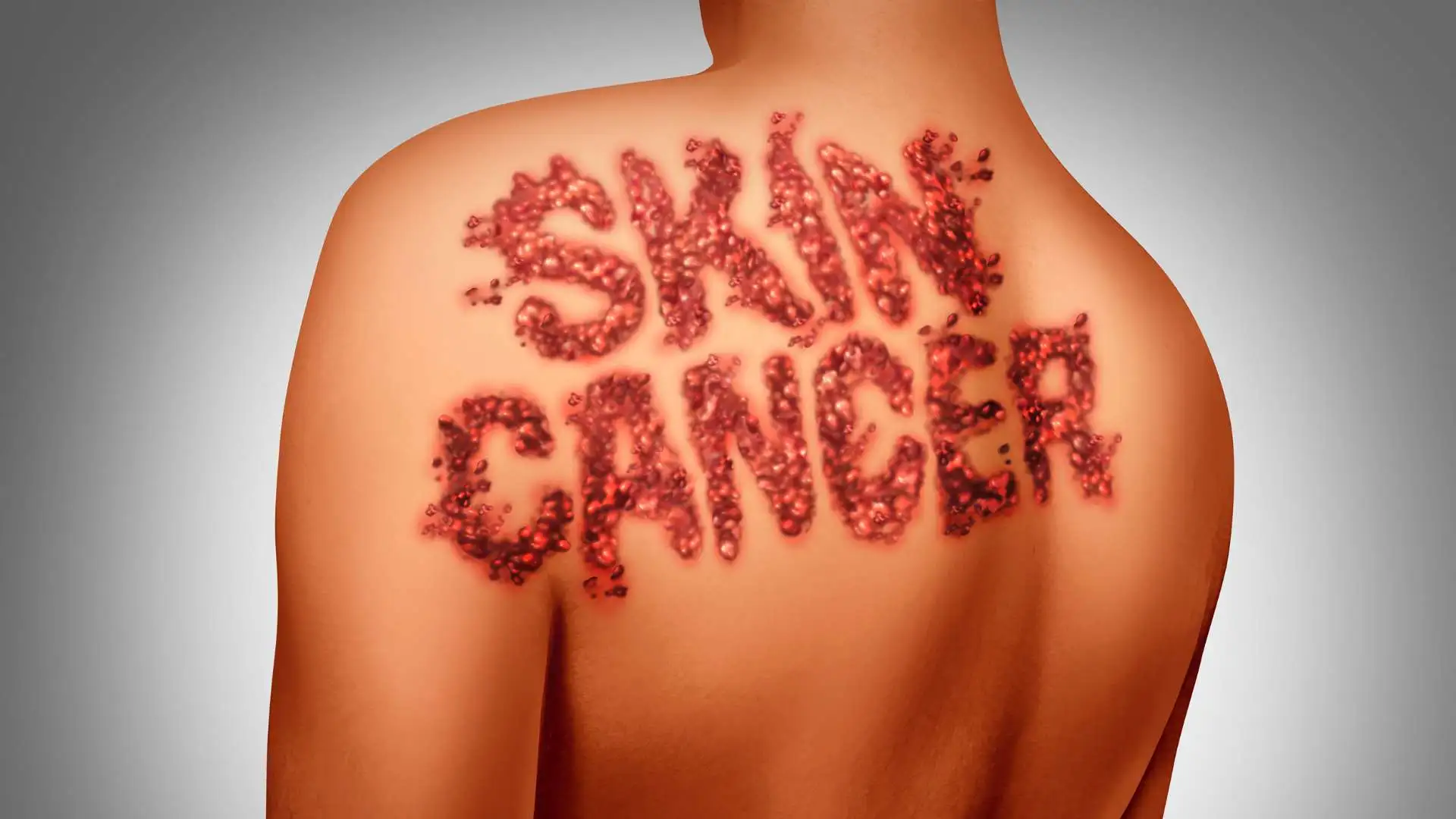 Study Reveals Decline In Skin Cancer Rates Among Young Adults