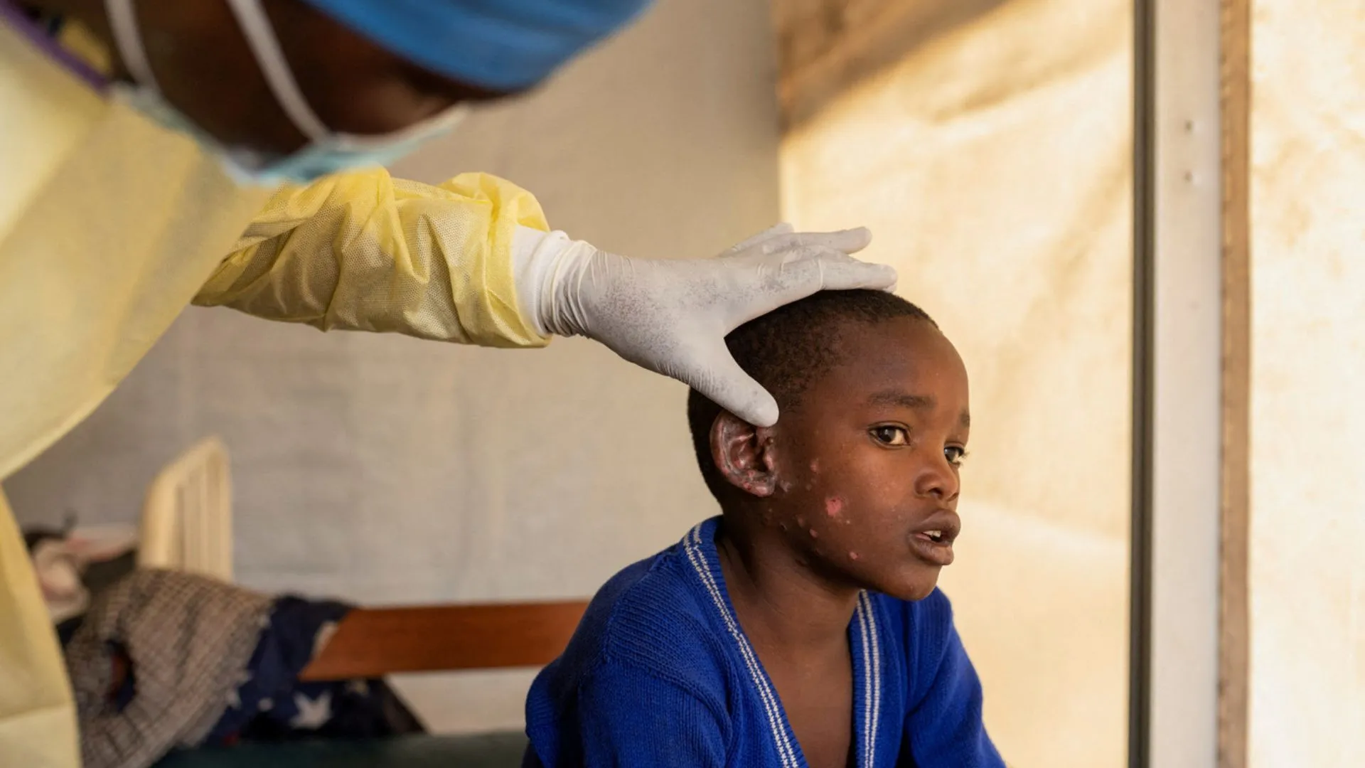 First Mpox Test Approved By WHO To Aid Global Response