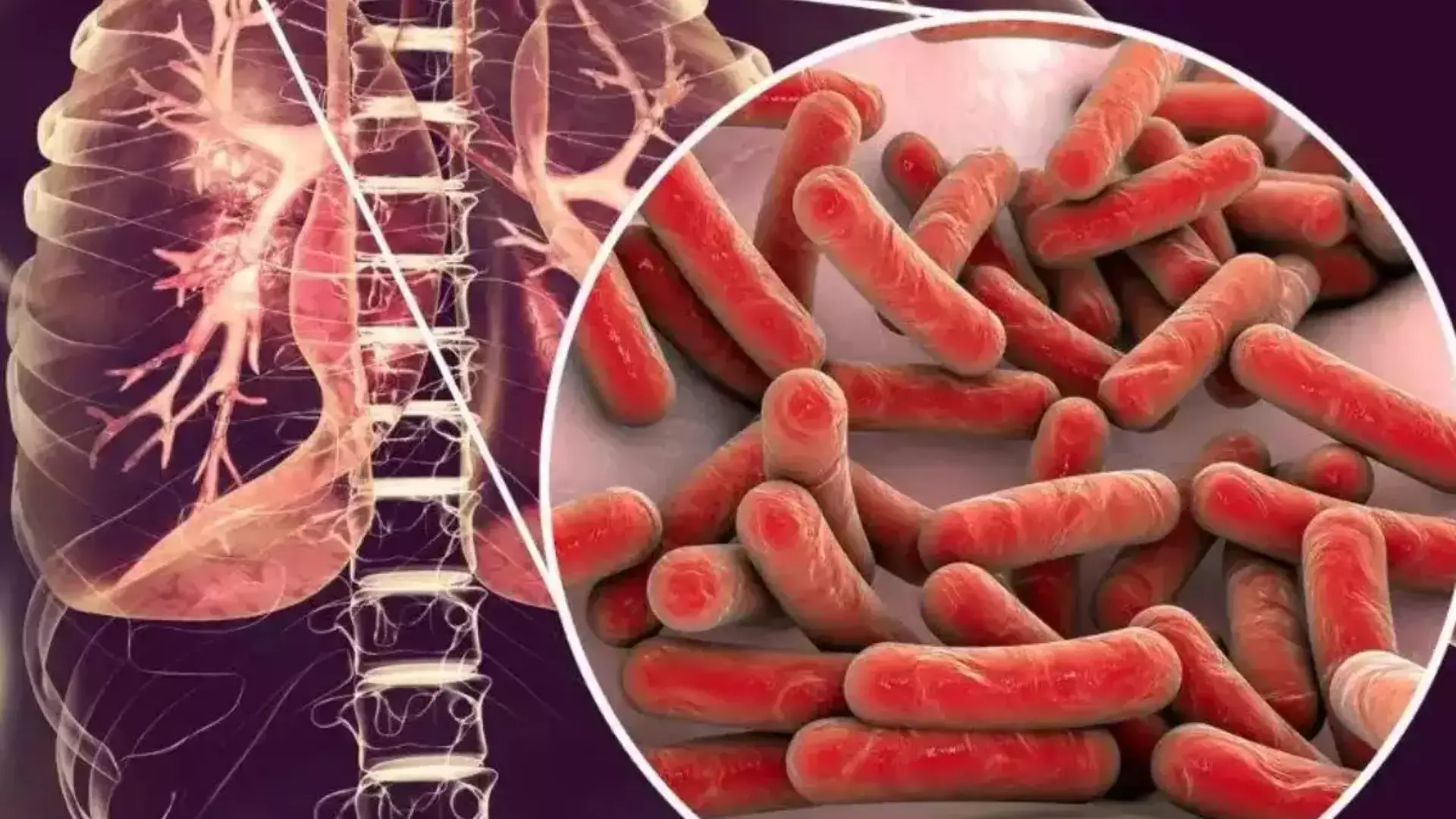 Tuberculosis Now At Higher Risk Than Covid-19, Leading Killer Disease Globally