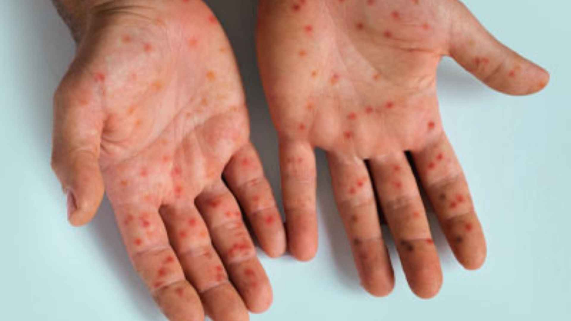 WHO Approves First Diagnostic Test for Mpox