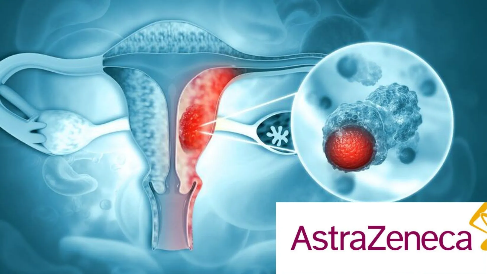 AstraZeneca Receives Nod To Launch Lynparza For Advanced Endometrial Cancer Treatment In India