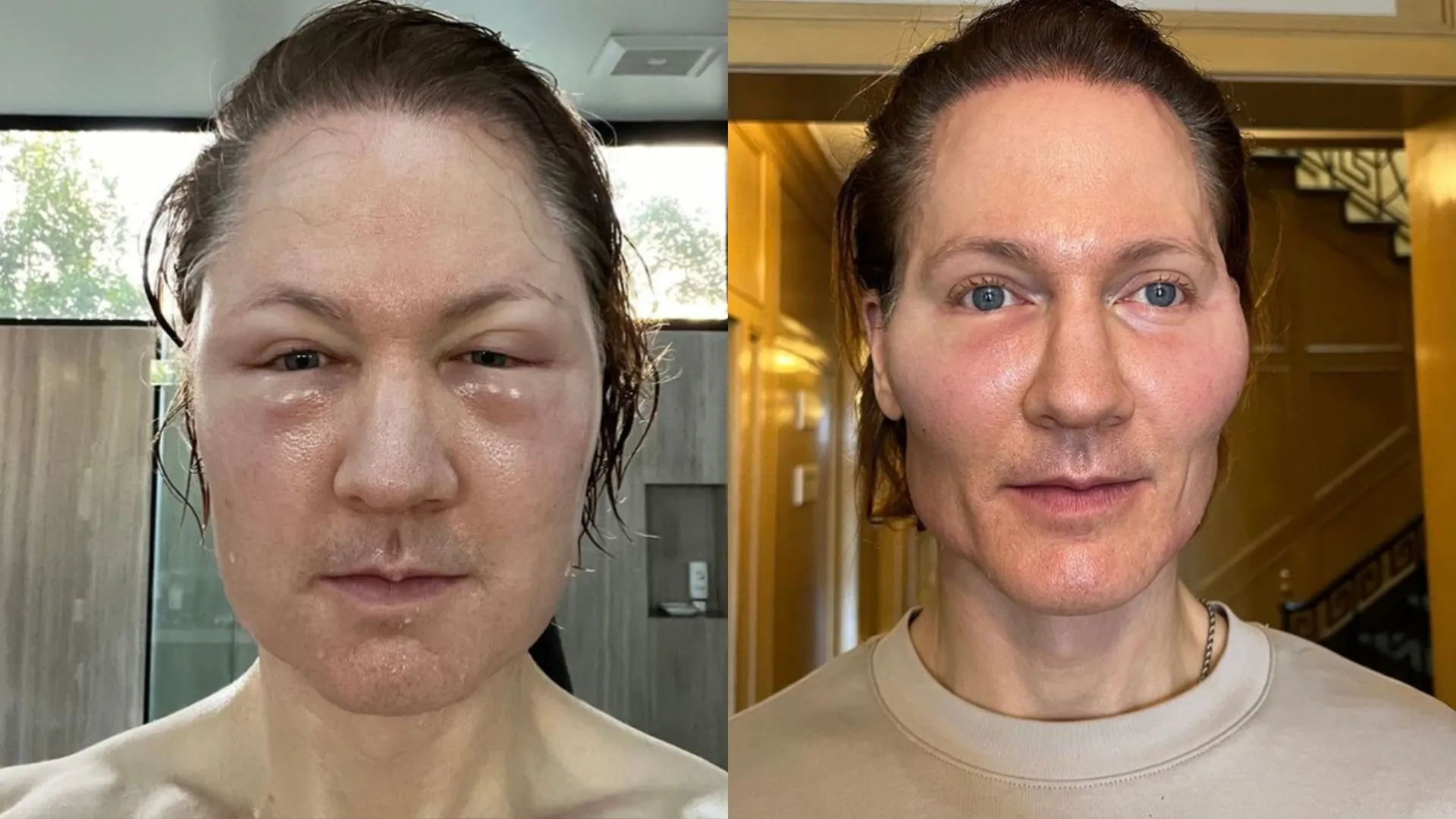 What Is Project Baby Face? Anti Aging Experiment Blows Up Tech Mogul Bryan Johnson’s Face