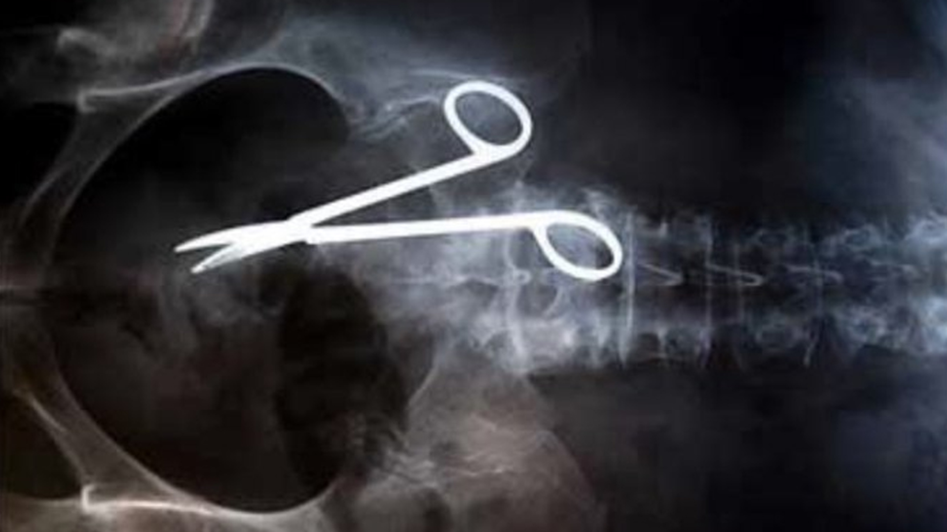 After Two Years Of Stomach Cancer Surgery, Scissors Found In Woman’s Stomach