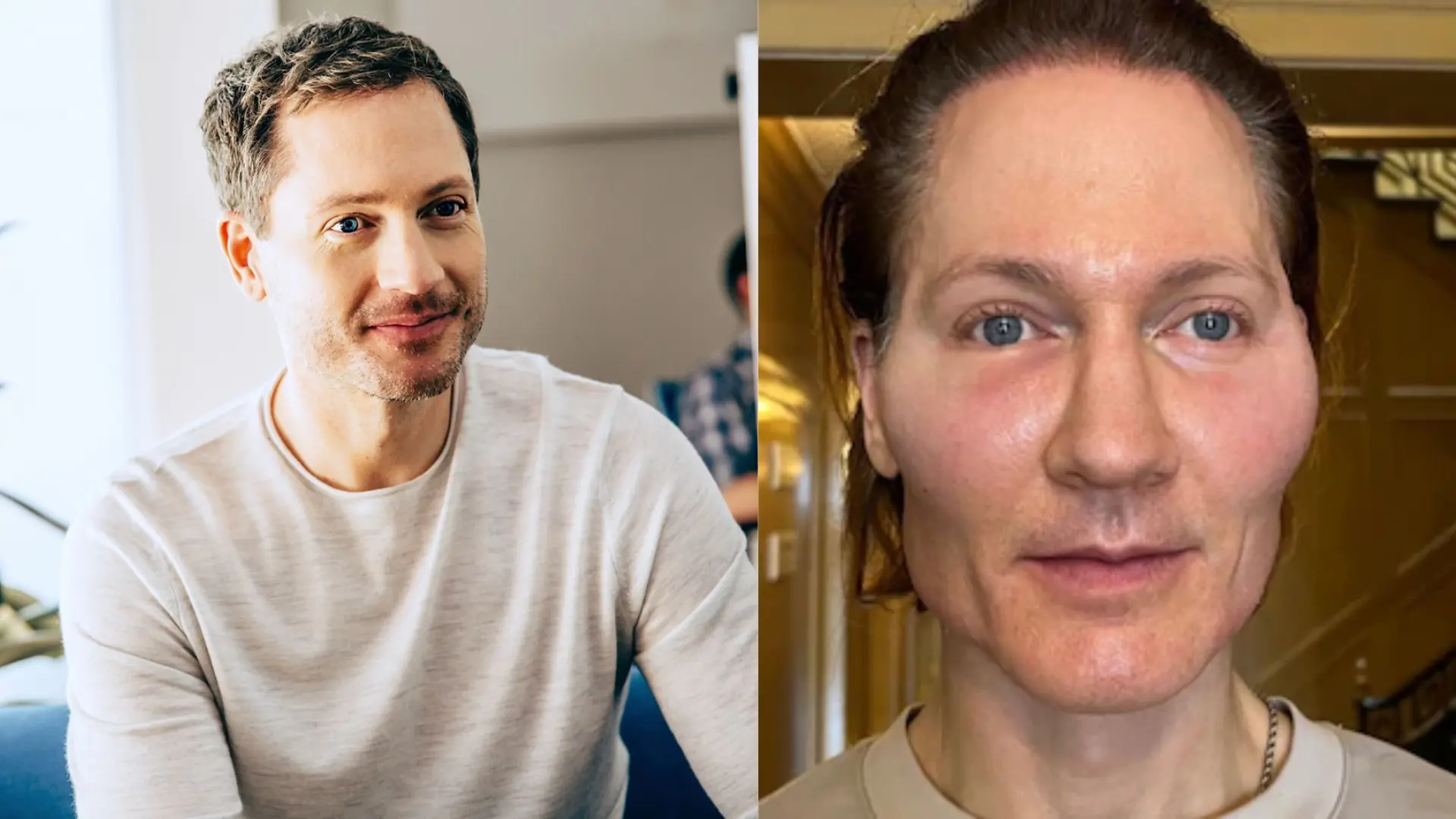 Bryan Johnson’s “Project Baby Face” Causes Severe Allergic Reaction In An Anti-Aging Procedure, ‘Swollen And Red Face’