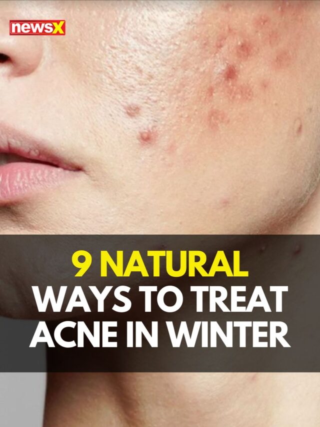 9 Natural ways to treat acne in winter