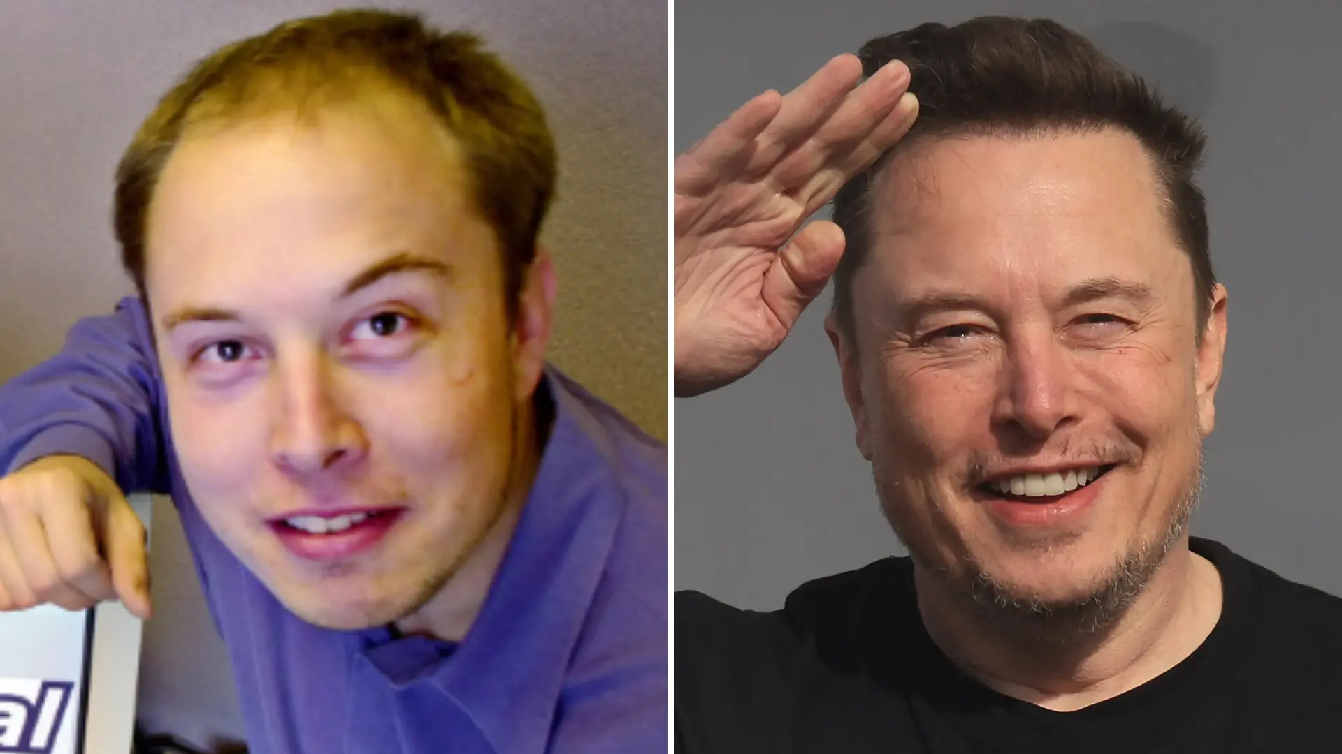 How Much Did A Balding Elon Musk Spend On His Hair Transplant? Tesla Boss Once Made Fun Of His Receding Hairline