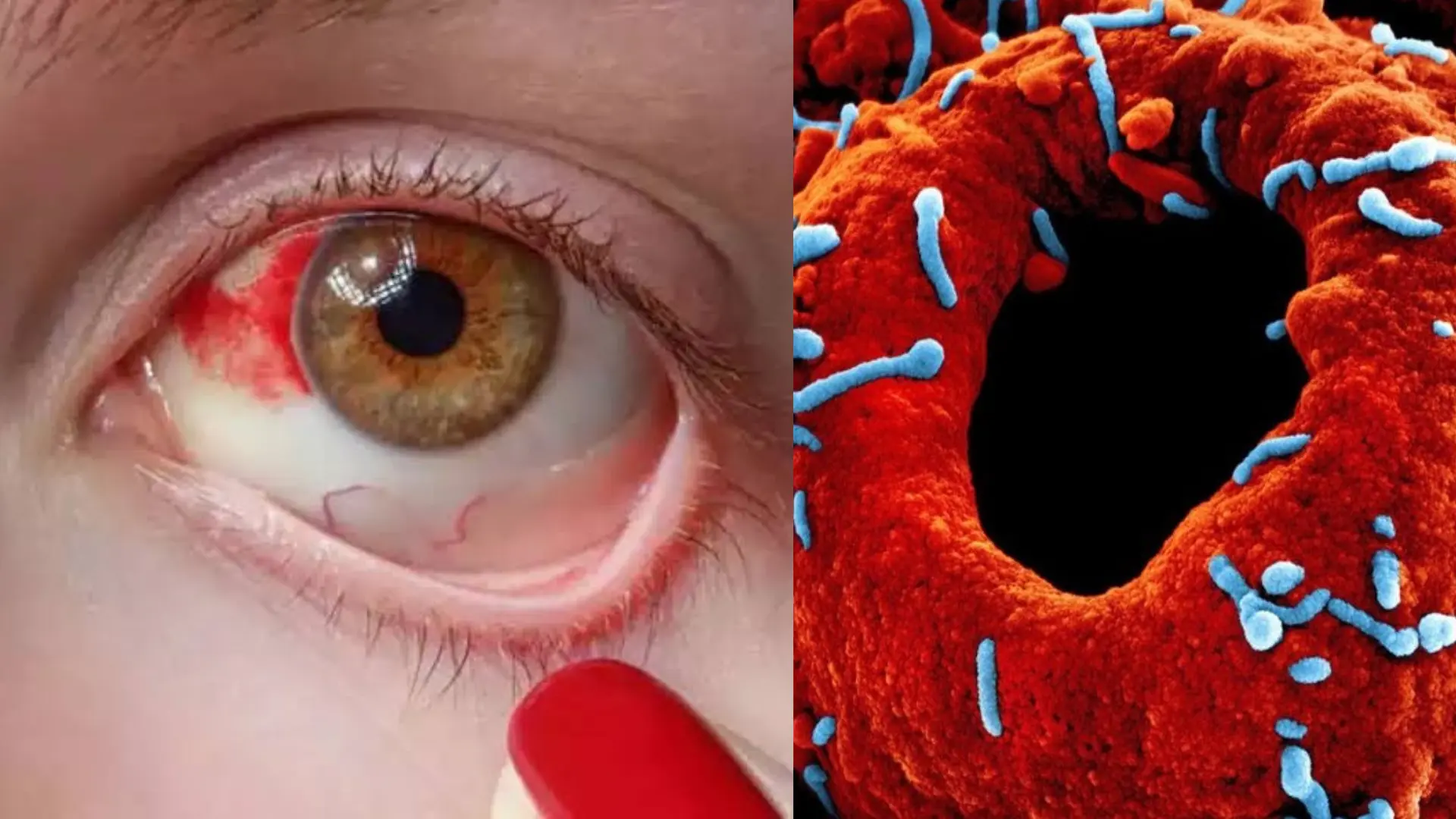 ‘Bleeding Eye’ Virus Emerging As A Health Threat: Here’s Everything You Need to Know