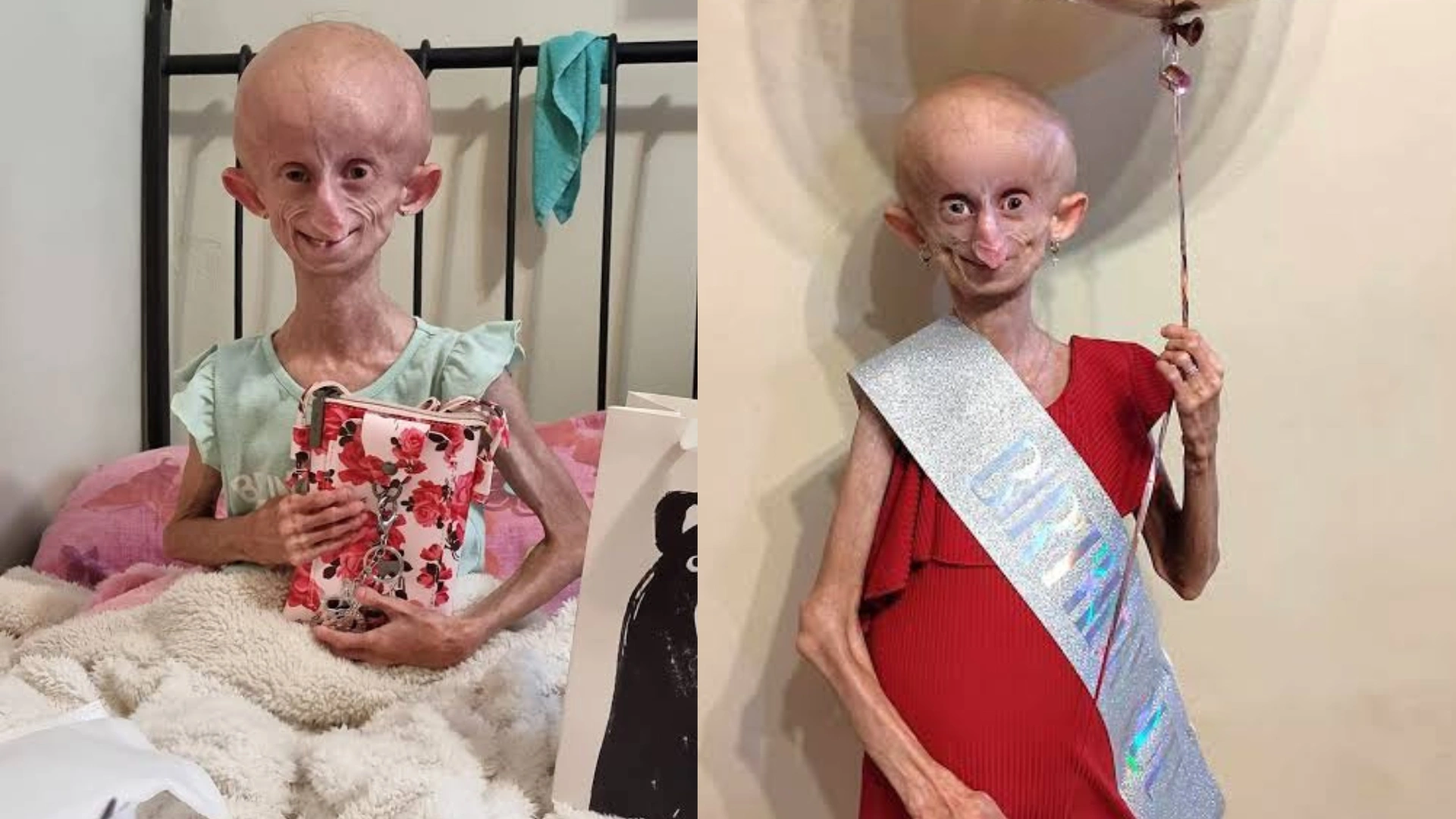 South African TikTok Star Beandri Booysen Passes Away Battling Progeria, Know About The ‘Rare’ Aging Disease