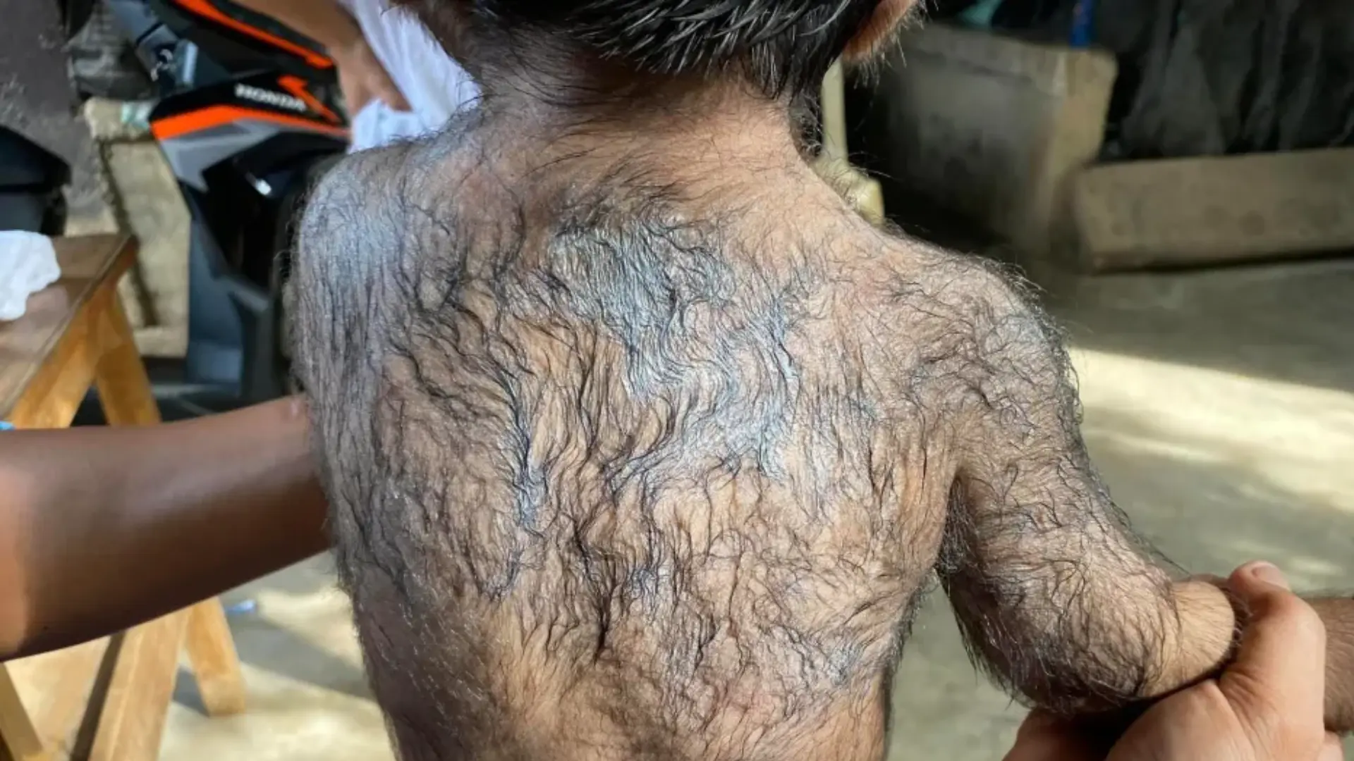 Minoxidil Poisoning In Babies Leads To ‘Werewolf Syndrome’—What Parents Need To Know