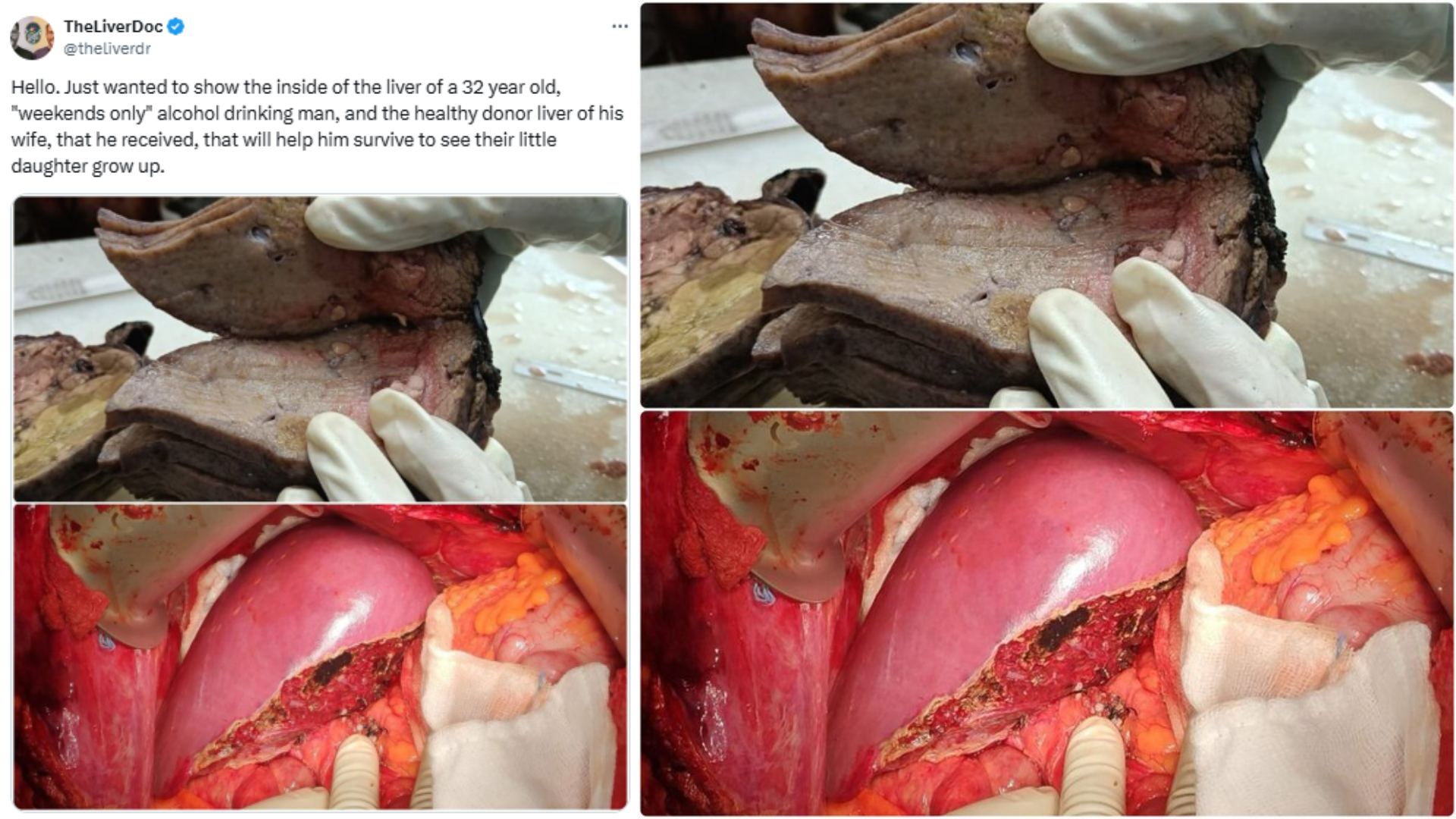 WARNING! Indian Doctor Shares Scary Image Of ‘Only Weekend Drink’ Liver Vs His Healthy Wife’s Liver