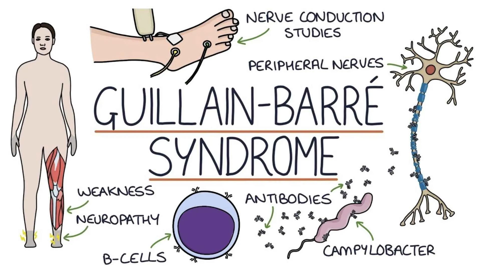 What Is Guillain-Barre Syndrome? 1 Died, 101 Patients Infected In  Maharashtra