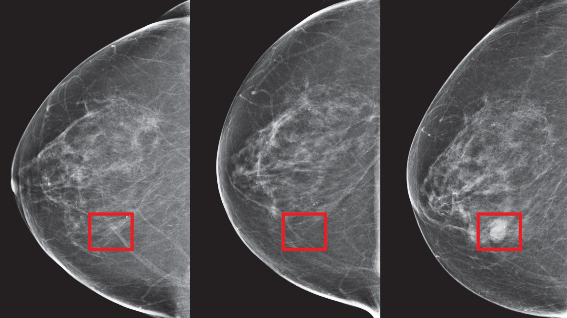 MIT Researchers Develops ‘Mirai’, An AI Model That Can Detect Breast Cancer Up To 5 Years Pre-Clinical Diagnosis