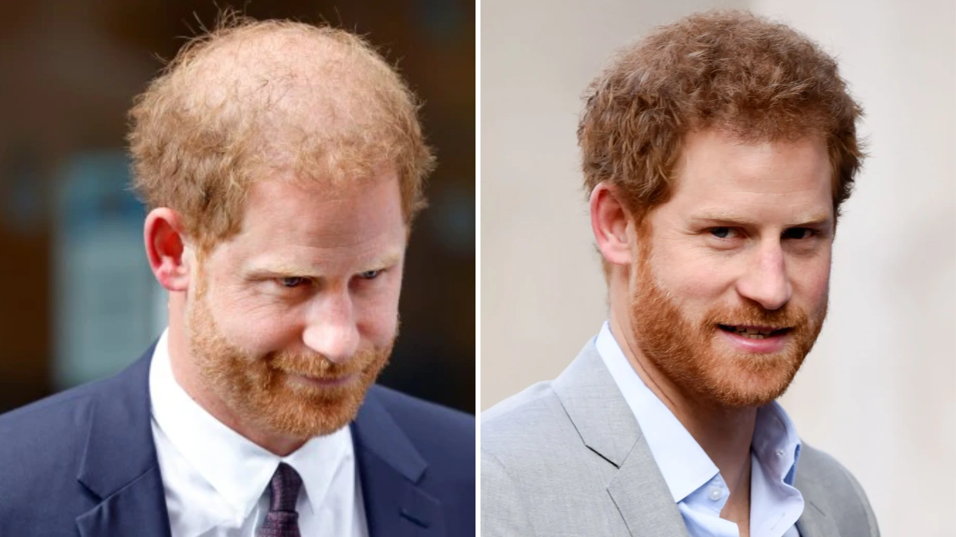 Did Prince Harry Opt For Hair Transplant Procedure? New Pic Of His Head Full Of Hair Surfaces- See Pic!